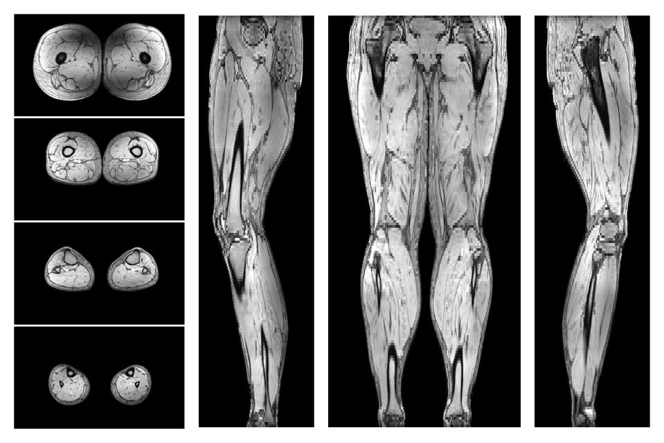 The out-phase image of the dixon reconstruction for water fat quantification.